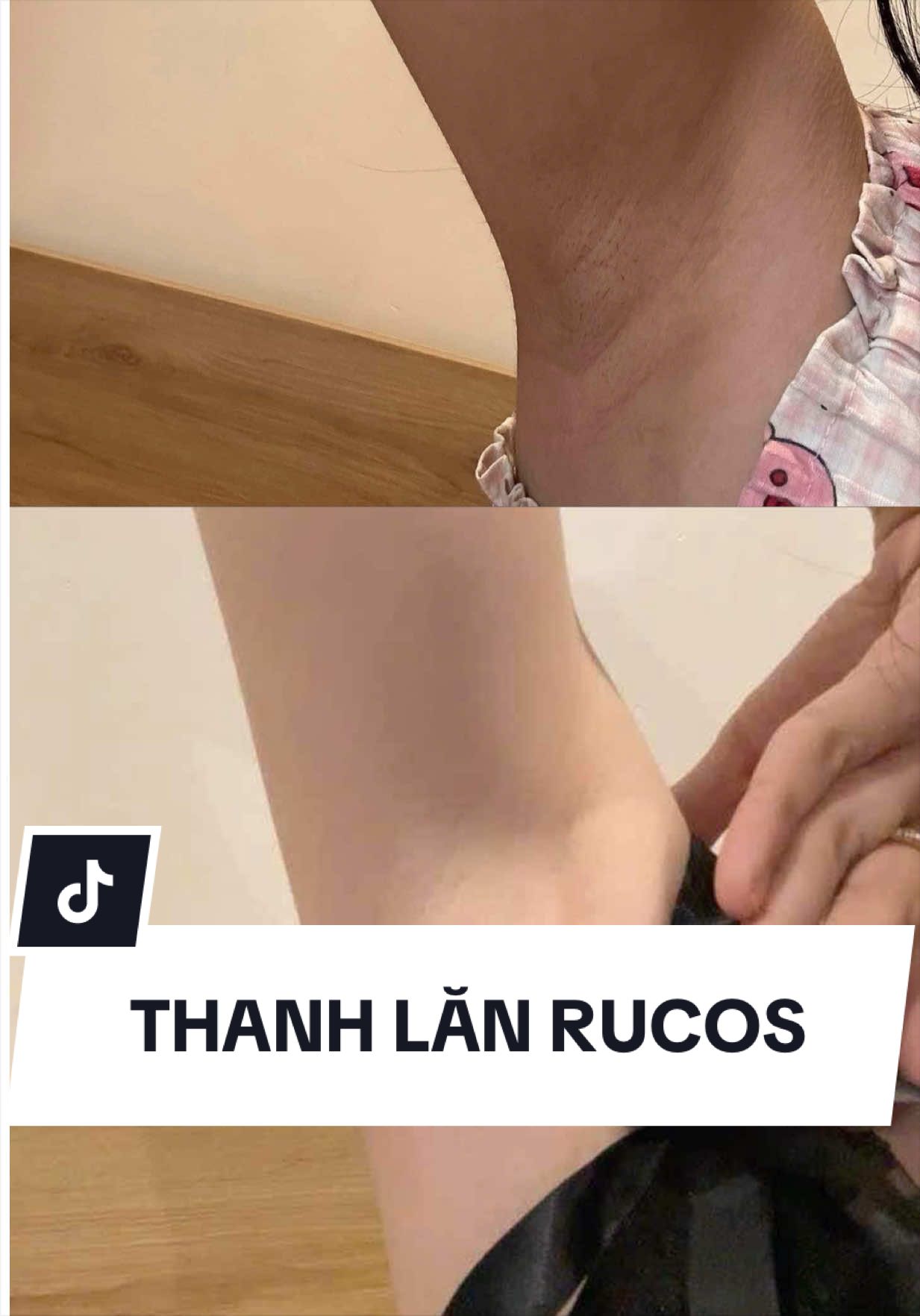 có đợt đi triệt ở một spa nọ, bth nách trắng chỉ mún đi triệt thôi mà nó làm banh cái nách, đen thui luôn má. May t dùng con này, kiểu fomo thôi mà dùng thời gian mới thấy kết quả #rucos #nghienskincarekhoahoc #trangda #creatorsearchinsights 