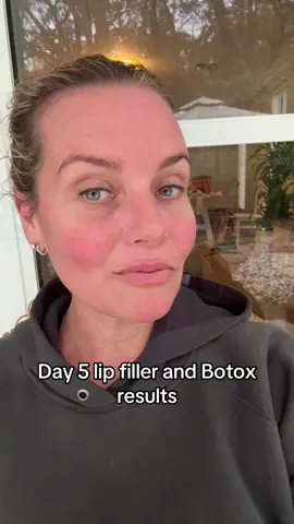 Day 5 lip filler and Botox results. I got this done in Bali with @Dr. Patricia 👩🏻‍⚕️ #lipfiller  #botox #bali 