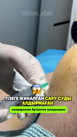 БУЫНДАҒЫ САРЫ СУДЫ АЛМАСА НЕ БОЛАДЫ? 🛑 Тізедегі сары су — жай ісік емес, буындағы қабынудың белгісі. Уақытында емдемесе: ❌ Шеміршек бұзылып, артрозға әкеледі ❌ Ауырсыну мен ісіну күшейеді ❌ Буын бүгілмей, жүру қиындайды ❌ Инфекция түссе, іріңдеп кетуі мүмкін Сондықтан буындағы артық сұйықтықты дер кезінде емдеу өте маңызды. ✅ Пункция (суды алу) ауырсынуды азайтып, буындағы қысымды түсіреді. ✅ Ең бастысы — тек суды емес, оның пайда болу себебін де емдеу қажет. 👨‍⚕️ Буын ауруларын 15 жылдық тәжірибесі бар дәрігер операциясыз, заманауи әдіспен емдейді. 📞 Жазылу: 8 (707) 567-99-28 📍 Астана қ., «Балжан» клиникасы 👇 Директке «БУЫН» деп жазың