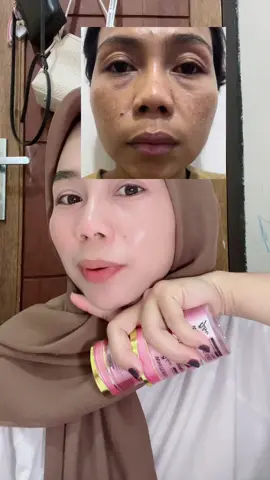 flek tebel,flek menahun,melasma,bekas jerawat,hempaskan pake#creamkelupas #creamkelupasjilvie #jilvieskincare #flekhitambandel #melasma  