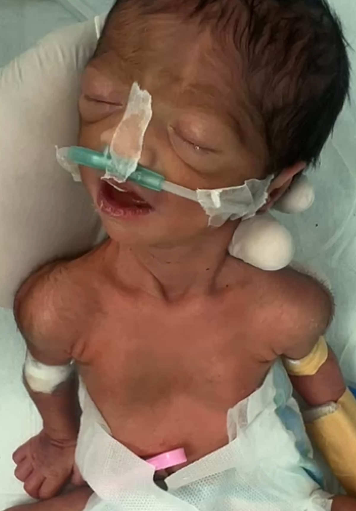 Preterm baby not responding #pretrem #usa🇺🇸 #unfreezemyaccount 