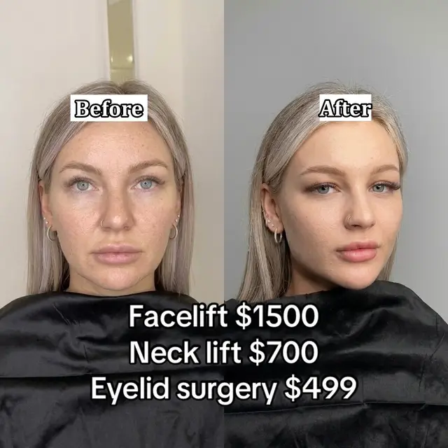 Dr. JangJi's Deep Plane Facelift method completely removes excess sagging and wrinkles, resulting in a slimmer, younger, and more beautiful face. #facelift #necklift #surgery #tiktokmalaysia🇲🇾 #DrJangJi 