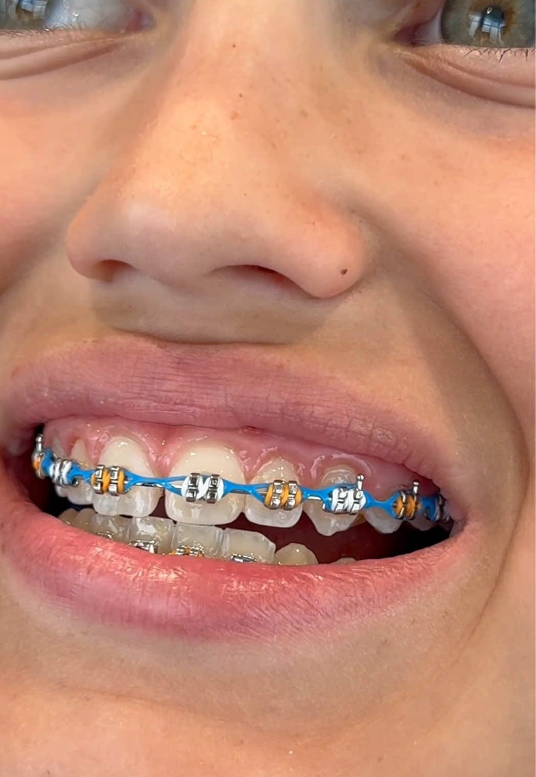 New York Knicks braces colors 🏀 #braces #knicks #newyork #basketball #nbafinals