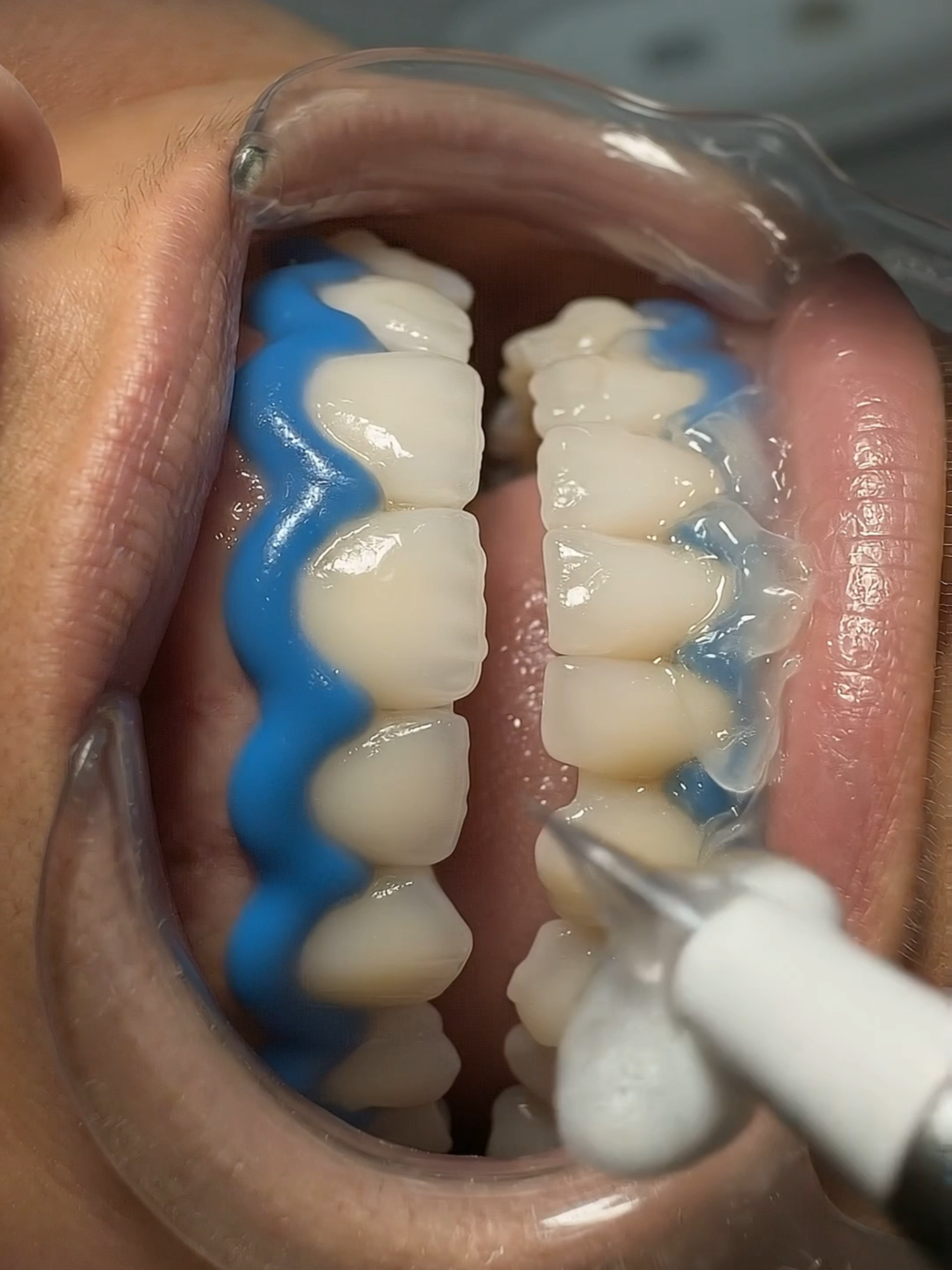 Real Dental Practice 🦷 Working Under Any Conditions 🦷 Real dental work 🦷 Dental practice moment 🦷 Doctor dedication 🦷 Clinic behind the scenes 🦷 Respect for healthcare workers #shorts #dentist #dental #dentistry #dentalpractice #dentalclinic #doctorlife #medicalshorts #healthcare #oralhealth #dentalcare #cliniclife #workhard #respect #behindthescenes #en igmadent