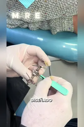 Definitivamente, este es un caso de alta complejidad. Nuestra paciente presentaba mordida cruzada, un maxilar superior estrecho y además algunas piezas dentales ausentes, por lo que no era un caso completamente estable ni sencillo de resolver. En Dentika Brackets realizamos una evaluación completa, incluyendo estudios radiográficos y tomográficos, para planificar cada etapa del tratamiento. En este caso usamos MARPE para expandir el maxilar superior de forma más controlada y trabajar primero la parte ósea antes de pasar a la corrección dental con brackets. Cada sonrisa tiene una historia, y cada caso necesita un diagnóstico preciso. Aquí no improvisamos: planificamos, evaluamos y resolvemos casos reales. 💚 #MARPE #MordidaCruzada #Ortodoncia #CasosReales #DentikaBrackets