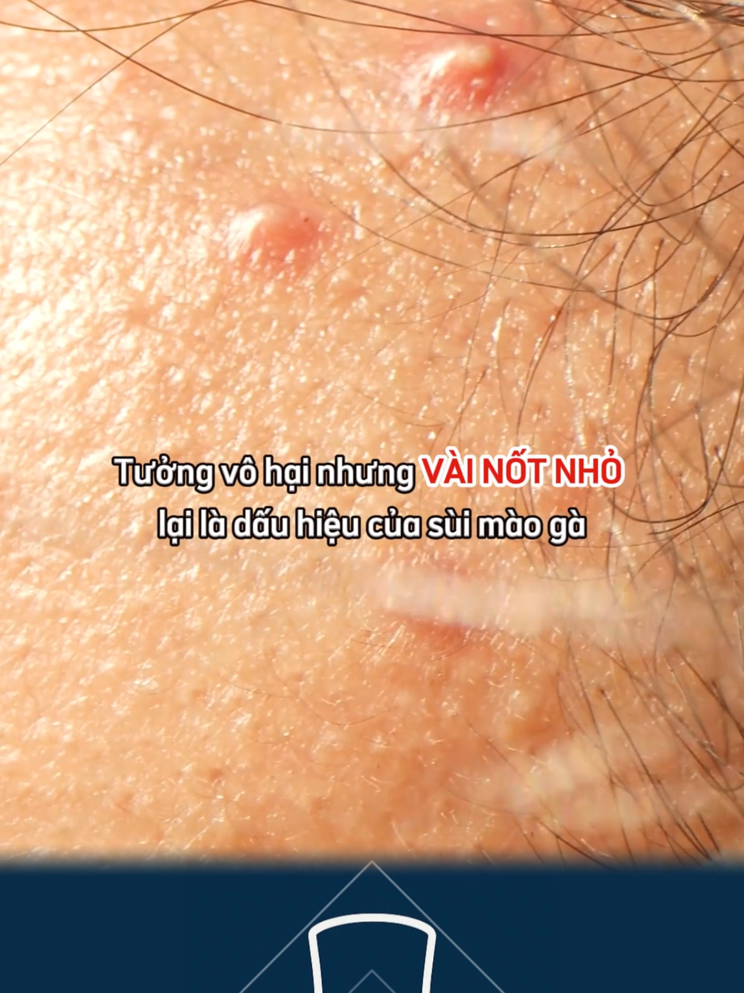Chỉ vài nốt nhỏ trên dương vật nhưng có thể là bệnh nguy hiểm. Bạn đang có biểu hiện này không? #namkhoa #benhnamkhoa #benhxahoi #smg #viralvideo
