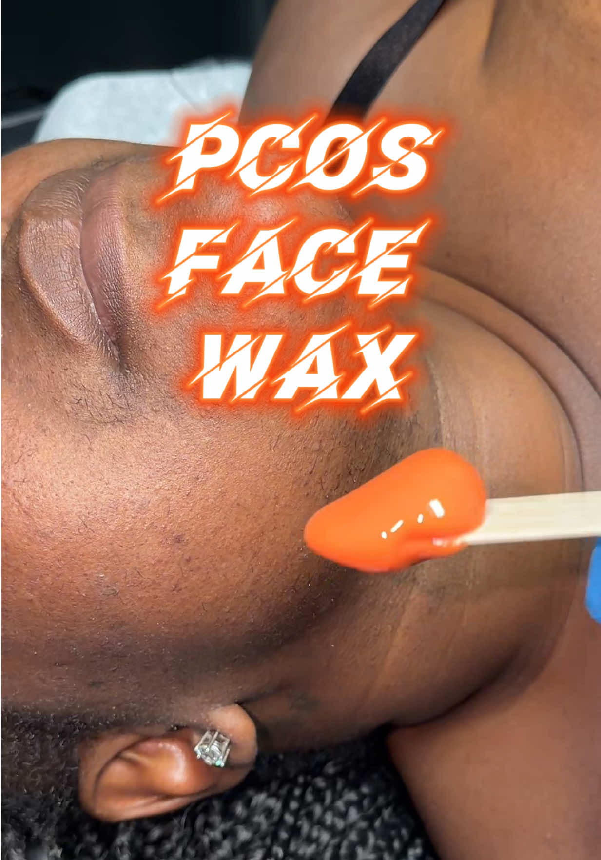 PCOS face wax with Coral wax by @Italwax USA 🧡🧡 #fyp #pcos #hirsutism #esthetician #wax 