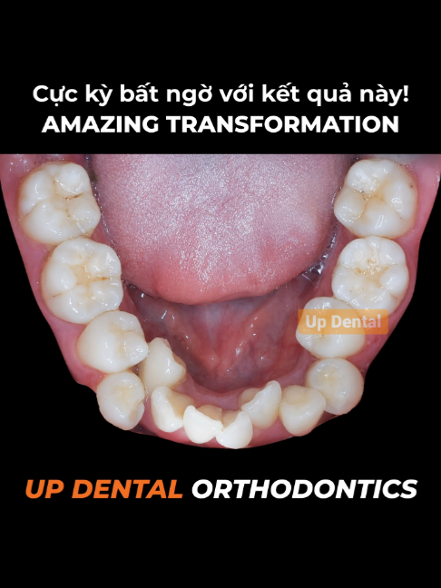 Metal braces results for tooth misalignment #updental #dental #dentist #braces #niengrang #viral #nhakhoauytin #trending #xuhuong #orthodontist