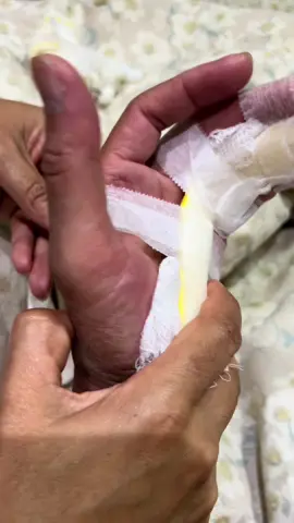 Retirando bandagem satisfatorio #viralvideo #foryou #gesso #brasil #foryoupage 
