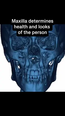 Maxilla has a huge impact #maxilla #forwardgrowth #palateexpander #facemask #mewing 