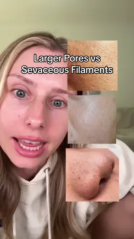 Products recs as well:  @epii_global  @IUNIK  @Dermaquest  #largepores #pores #cloggedpores #skincaretips #skincare 