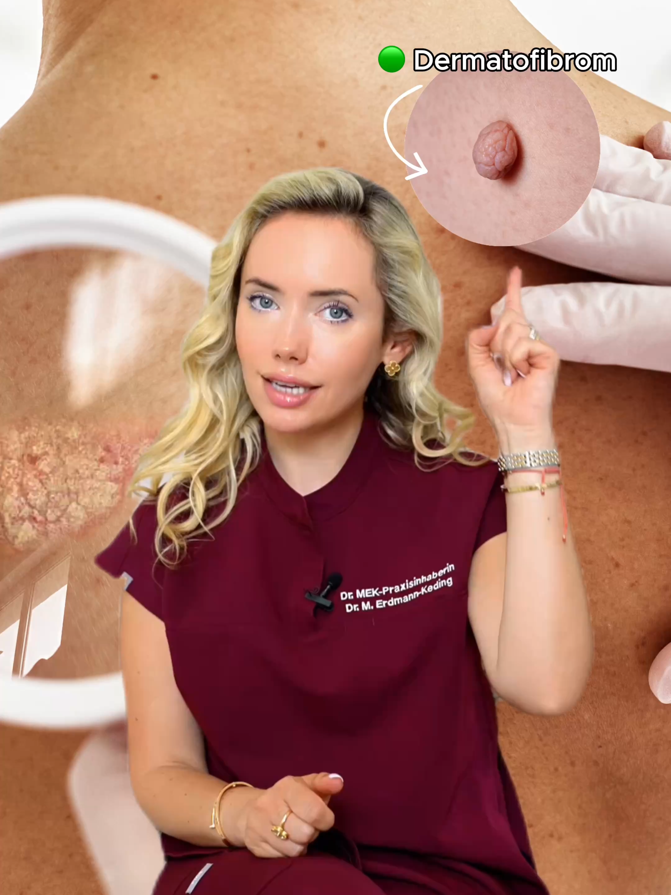 Hautkrebs: Gutartig oder bösartig? 🔬 Flecken auf der Haut verändern sich oft unbemerkt – und das Geheimnis liegt darin, die Warnsignale rechtzeitig zu erkennen. Ob harmloses Muttermal oder gefährlicher Hautkrebs – wer seine Hautveränderungen gezielt im Blick behält und regelmäßig zur Vorsorge geht, kann seine Gesundheit besser im Blick behalten. . . . #skincarehacks #hautkrebs #skincancer #vorsorge