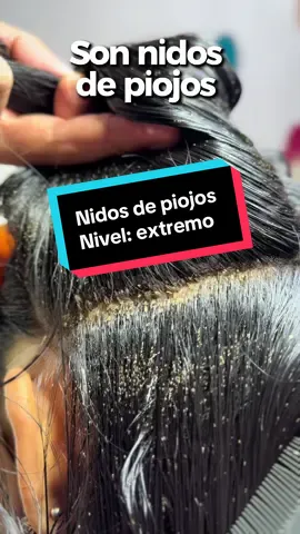 Son nidos de piojos encontrados en el cuero cabelludo durante la valoración inicial.  Por eso es tan importante realizar una revisión profesional completa y no confiar únicamente en tratamientos caseros o lavados comunes. #Piojos #Liendres #EliminacionDePiojos #SaludCapilar #Xalapa     