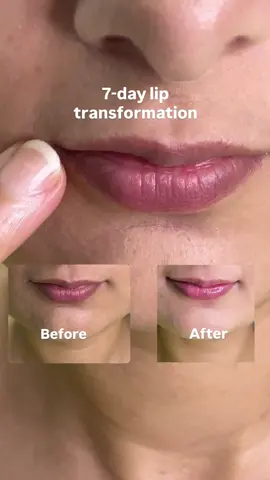 7 day lip transformation using K-secret seoul 1988 serum @KSECRET GLOBAL @KSECRET US  #glowskinwithretinal #hyperpigmentation #koreanskincare