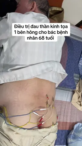 Đau thần kinh toạ #chamcuu #chamcuubamhuyet #chamcuutrilieu #dongy #trilieu 