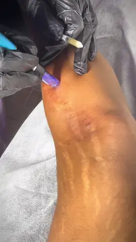 PRP stretch mark treatment #prp #prptreatment #stretchmarks #fyp #foryou 