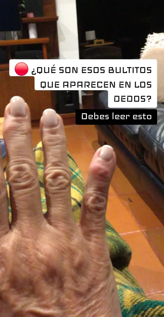 ✋ ¿Has notado pequeños bultos o protuberancias cerca de los dedos, nudillos, codos o articulaciones? Para muchas personas con artritis reumatoide, estos nódulos pueden convertirse en una de las manifestaciones más visibles de la enfermedad. Aunque suelen llamar la atención por su apariencia, los nódulos reumatoides son mucho más que un problema estético. Detrás de ellos existe un proceso inflamatorio complejo que involucra al sistema inmunológico, los tejidos articulares y el estrés celular. Hoy quiero explicarte qué son, por qué aparecen y qué estrategias nutricionales pueden ayudar a apoyar la salud articular de forma integral. ❤️ 🦴 ¿QUÉ SON LOS NÓDULOS REUMATOIDES? Los nódulos reumatoides son acumulaciones de tejido inflamatorio que suelen aparecer debajo de la piel. Generalmente se observan en zonas sometidas a presión frecuente como: ✅ Dedos de las manos ✅ Nudillos ✅ Codos ✅ Antebrazos ✅ Talones ✅ Rodillas Pueden sentirse firmes al tacto y variar desde unos pocos milímetros hasta varios centímetros. Algunas personas apenas los notan. Otras pueden experimentar: 🔸 Sensibilidad al contacto 🔸 Molestia al sujetar objetos 🔸 Limitación funcional 🔸 Cambios visibles en la forma de las manos 🔥 ¿POR QUÉ APARECEN? La artritis reumatoide es una condición autoinmune caracterizada por inflamación persistente. Con el tiempo, esta inflamación puede afectar no solamente las articulaciones, sino también tejidos cercanos. Cuando el organismo mantiene procesos inflamatorios durante largos períodos, algunas células inmunológicas se acumulan en determinadas áreas formando estos nódulos. ✋ LO QUE MUCHAS PERSONAS NO SABEN Los nódulos son solamente la parte visible. Muchas veces representan lo que está ocurriendo internamente: ⚠️ Inflamación persistente ⚠️ Mayor estrés oxidativo celular ⚠️ Alteraciones inmunológicas ⚠️ Daño progresivo en tejidos 🥗 ALIMENTOS QUE PUEDEN APOYAR LA SALUD ARTICULAR La alimentación no reemplaza el seguimiento médico, pero sí puede convertirse en una herramienta importante para apoyar al organismo. 🐟 1. AUMENTA EL CONSUMO DE OMEGA-3 Fuentes recomendadas: 🐟 Sardinas 🐟 Salmón 🐟 Caballa 🐟 Anchovetas Los omega-3 participan en mecanismos relacionados con la respuesta inflamatoria del organismo. 🫐 2. MÁS FRUTAS RICAS EN ANTIOXIDANTES Incluye regularmente: 🫐 Arándanos 🍓 Fresas 🍇 Uvas moradas 🍒 Cerezas 🥝 Kiwi Los antioxidantes ayudan a proteger las células frente al daño oxidativo. 🥬 3. AUMENTA LOS VEGETALES DE COLORES INTENSOS Especialmente: 🥦 Brócoli 🥬 Espinaca 🥕 Zanahoria 🫑 Pimientos 🥗 Kale Aportan vitaminas, minerales y compuestos bioactivos beneficiosos para la salud celular. 🧄 4. UTILIZA ESPECIAS NATURALES Puedes incorporar: 🧄 Ajo 🟡 Cúrcuma 🫚 Jengibre 🌿 Orégano 🌱 Romero Son ingredientes ampliamente utilizados dentro de patrones alimentarios antiinflamatorios. 💧 5. HIDRATACIÓN ADECUADA El agua participa en múltiples funciones metabólicas y ayuda al correcto funcionamiento de los tejidos. Muchas personas subestiman este punto. ❤️ UNA VISIÓN MÁS AMPLIA Cuando observamos un nódulo reumatoide, no estamos viendo solamente un bulto. Estamos viendo una señal. Una señal de que el organismo necesita apoyo. Una señal de que la inflamación merece atención. Una señal de que las células requieren mejores condiciones para funcionar. Por eso cada vez más profesionales integran alimentación, actividad física adaptada, control del estrés, sueño reparador y apoyo nutricional dentro de un enfoque más completo para la salud articular. 📩 SI DESEAS CONOCER MÁS SOBRE NUESTRO ENFOQUE NUTRICIONAL Y EL PROTOCOLO ANTIOXIDANTE QUE MUCHAS PERSONAS UTILIZAN COMO COMPLEMENTO A SUS HÁBITOS DE SALUD, ESCRÍBEME POR PRIVADO. 📩 TAMBIÉN PUEDES CONOCER TESTIMONIOS DE PERSONAS QUE HAN COMPARTIDO SU EXPERIENCIA Y LOS CAMBIOS QUE HAN OBSERVADO EN SU CALIDAD DE VIDA. ❤️ TU CUERPO TIENE UNA GRAN CAPACIDAD DE ADAPTACIÓN CUANDO LE DAS LAS HERRAMIENTAS ADECUADAS. #ArtritisReumatoide #SaludArticular #InflamacionCronica #BienestarIntegral #VidaSinLimites