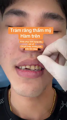 🦷Trám thẩm mỹ răng sâu, hình thể mẻ vỡ cho anh khách. inbox tư vấn & đặt hẹn #fyp #trám_răng_thưa #trám_răng_thẩm_mỹ 