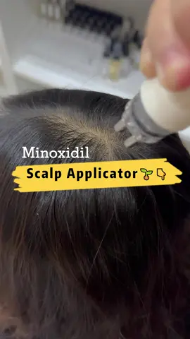 Minoxidil Applicator for Precise Scalp Application Minoxidil can be very runny and difficult to control, so using an applicator makes targeted application simple. I ordered an applicator that allows me to put the solution exactly where I want it on my scalp. The applicator accepts my minoxidil poured directly into it, then dispenses through small metal tips at the end for precise placement. I place the metal tips on the scalp and deliver the solution to the desired spots, then massage it into the scalp. This method lets me apply minoxidil directly to the scalp without parting my hair, reducing waste and mess. The applicator works with standard minoxidil solutions, including Kirkland formulas, and is labeled as a MINOXIDIL APPLICATOR or Minoxidil Applicator. For best results: pour the minoxidil into the applicator reservoir, aim the metal tips at the scalp where regrowth is needed, dispense a measured amount, and gently massage until absorbed. I'll link the applicator below for easy reference. Have you tried a metal-tip applicator for minoxidil? Share your experience or questions below. Keywords: minoxidil applicator for scalp, precise minoxidil application, how to apply minoxidil without parting hair, minoxidil metal-tip applicator, apply minoxidil directly to scalp, minoxidil applicator kirkland, best applicator for minoxidil, minoxidil application tips, use minoxidil in hair applicator, targeted minoxidil application. #minoxidil #hairgrowth #minoxidilapplication #hairtok #haircareroutine 