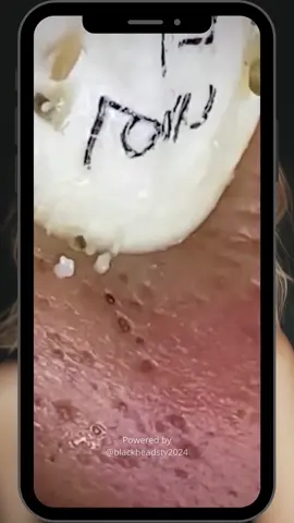 Squeeze Popping Acne Pimple Satisfying Abcess Blackheads Removal Pimple Removal | Viral #blackheadsremoval #cleanskin #acnetreatment #pimplepopping #foryoupage 