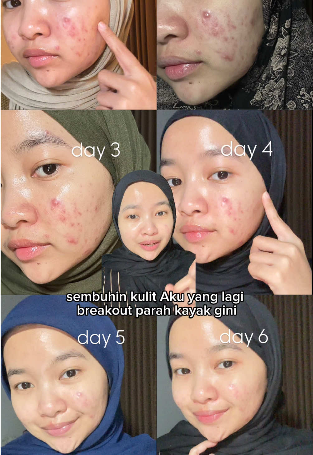 mnurutku yg kondisi kulitnya sama kayak aku cobain deh intensive balm cream ini!! #moisturizer #acneskin #acnefighter #intensivebalmcream 