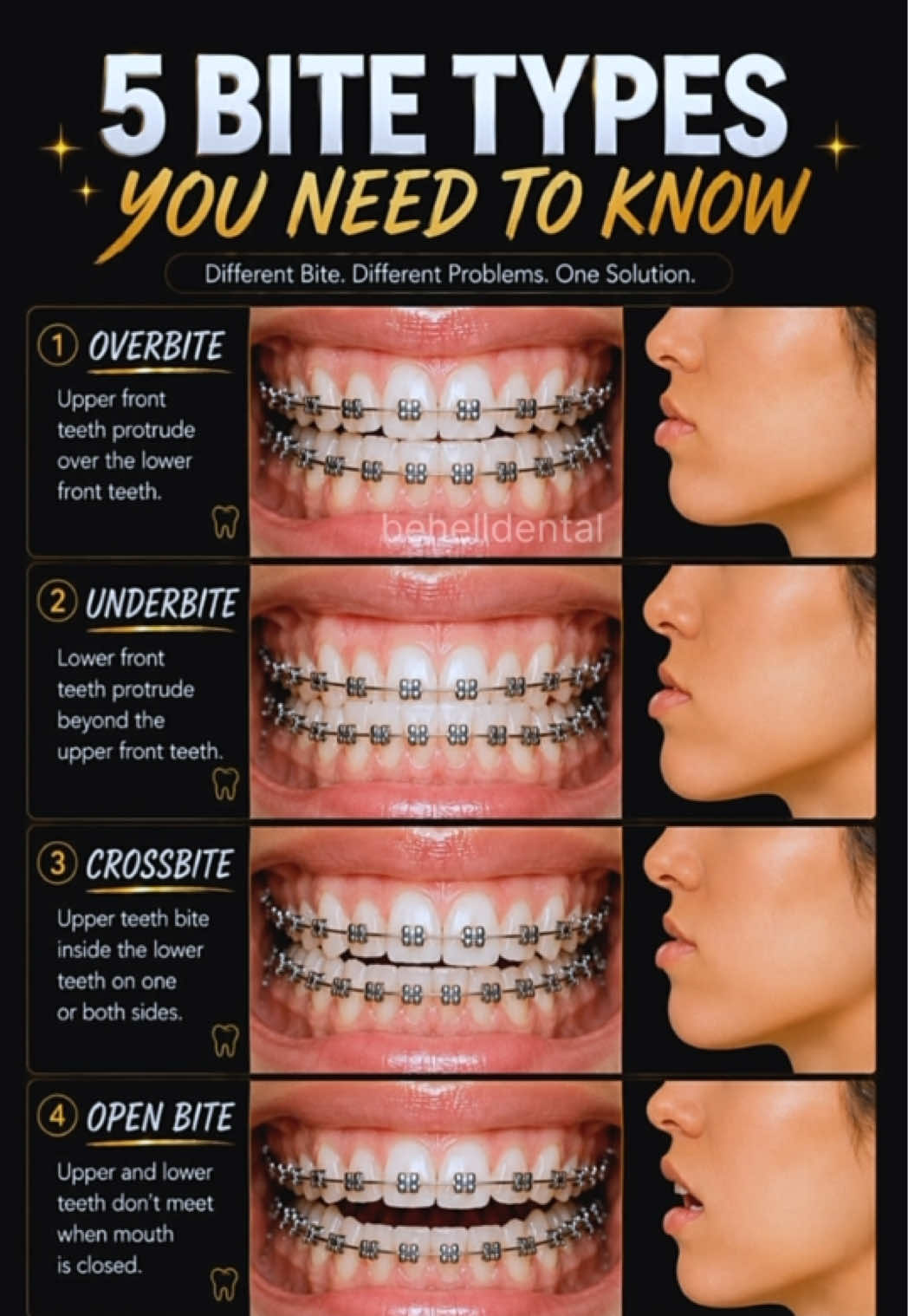 Kamu termasuk yang mana? Setiap jenis gigitan memiliki karakteristik dan penanganan yang berbeda. Pemeriksaan sejak dini dapat membantu menjaga fungsi mengunyah, kesehatan gigi, dan keharmonisan senyum.