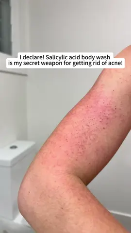 #🚿 #acne #bodywash #bodycare #body #fyp #skin #quarxery #mite #mites #foryou
