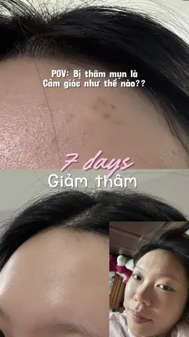 😴 thật sự là 7 ngày vết thâm của tui giảm 80-90% ròi #serumkanstrắng#KANSWHITENINGESSENCE#KANS#duongtrangda#Niacinamide