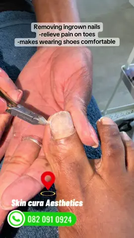 Tell me why are you still sitting with those painful toe nails due to ingrown nails 🤷🏾‍♀️your shoes are so uncomfortable to wear and your natural nails are even changing colour 🤦🏽‍♀️ You deserve to enjoy wearing your shoes and pain free toes🫵🏽 Now book appointment 🗓️👇🏾 📍Pretoria, faerie glen  ☎️082 091 0924 📍Rusternburg,safari Tuine  ☎️082 442 0123 #skincuraaesthetics #beautyhacks #skincaretips #pedicure #ingrowntoenailremoval 