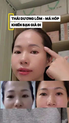 Tập 2 nhóm cơ này trong 30 ngày cải thiện thái dương lõm má hóp #lõmtháidương #máhóp #tậpcơmặt