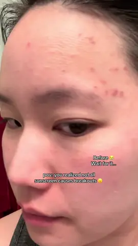 Where has this #skin1004 #koreansunscreen for #acneprone skin been all my life 😩 #acneskincare #tiktokshopcreatorpicks @SKIN1004 US 