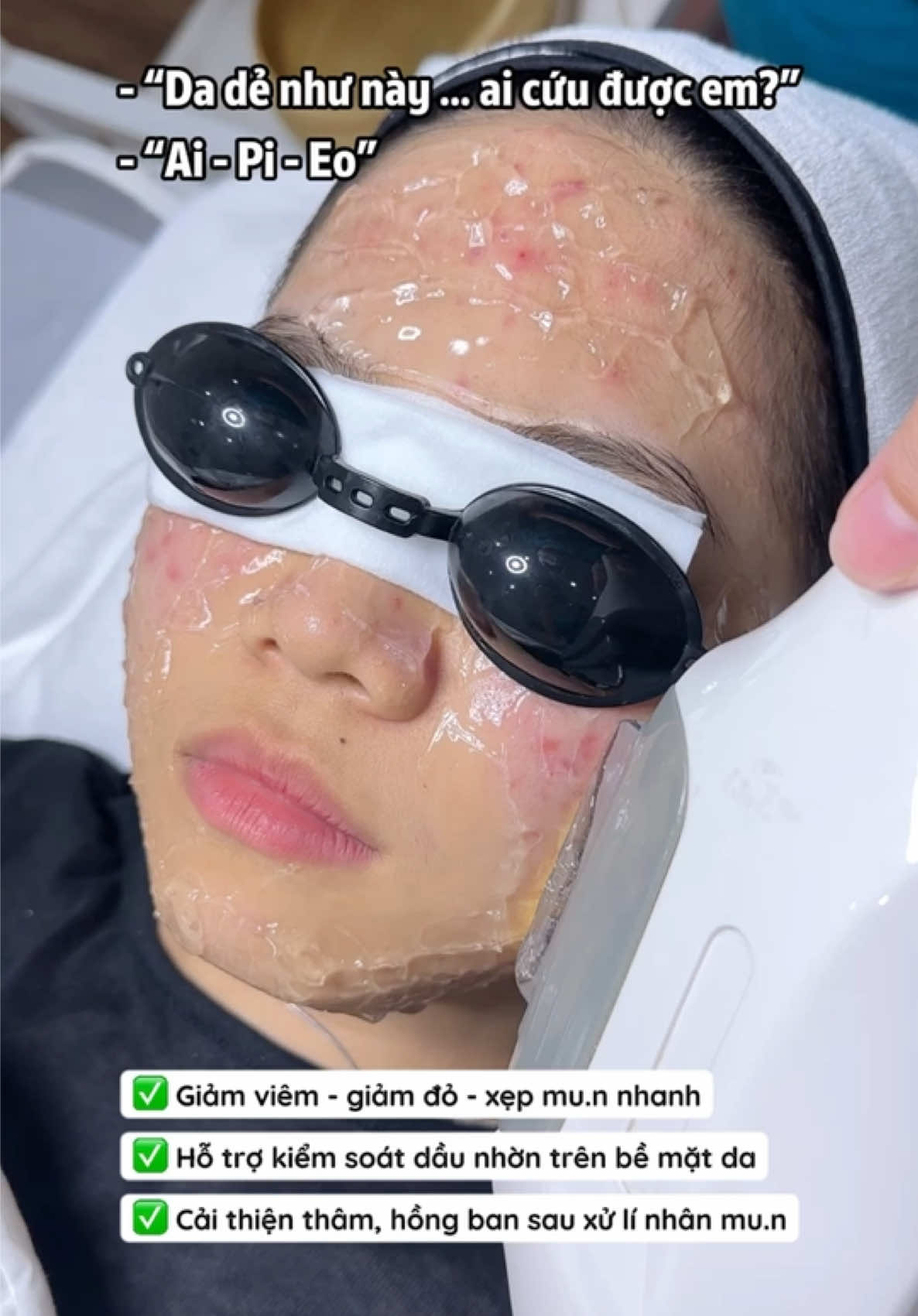 #creatorsearchinsights Da nào nên tìm hiểu IPL? 👇 • Da dễ lên mu.n • Da nhiều dầu • Thâm đỏ, hồng ban • Da xỉn, không đều màu • Da cần cải thiện tổng thể #damun #chamsocda #xuhuong #ipl 