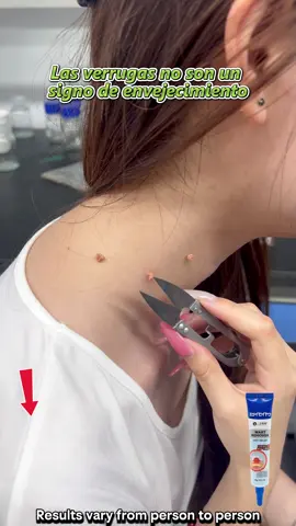 Esta crema para eliminar verrugas puede ayudarte a tratar la mayoría de las verrugas  de la piel. #verrugas #warts #skincare#hpv#wartremoval QQ 