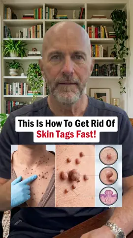 This Is How To Get Rid Of Skin Tags Fast! #skintags #skincare #health #dermatology #wellness 