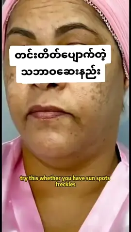 #Aမိုး #အမဲစက်၊တင်းတိပ်ရှိသူများအတွက် #09663354833 #အာမခံချက်အပြည့်ရှိတယ်နော် 