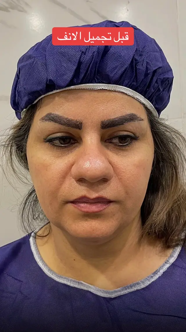 قبل وبعد عمليه تجميل الانف #تجميل_الانف #طب #عمليات_تجميل #تجميل_الوجه #تجميل_نساء 