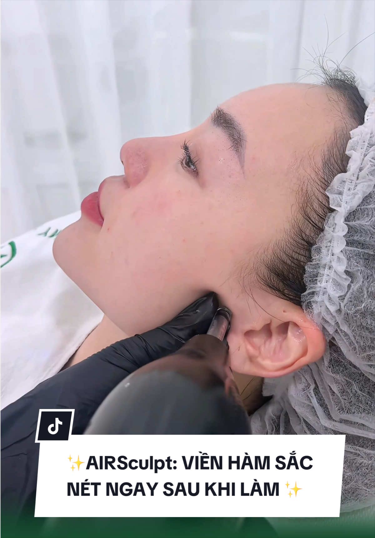 Chỉ sau 1 lần AIRSculpt... khác biệt đến mức này ⁉️ 👉 Đường VIỀN HÀM SẮC NÉT hơn 👉 Tầng mặt giữa được NÂNG RÕ 👉 Gương mặt cải thiện đến 70–80% so với ban đầu 🏥 AIRSculpt tại Phòng khám Chuyên khoa Thẩm mỹ & Da liễu AMY ACADEMY – phác đồ cá nhân hóa, được bác sĩ trực tiếp thăm khám và chỉ định theo từng cấu trúc gương mặt 🍀💚 #amyAcademy #AIRSculpt #trehoa #lamdepcongnghecao #lamdepchuanykhoa