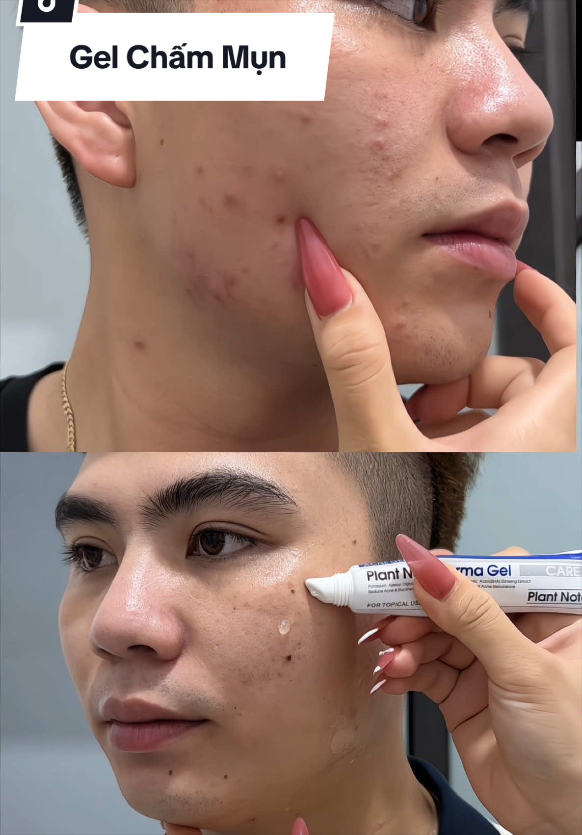 Da bị mun thì xài thử tuýt này nè , xài êm lắm lun nha #gelchammun #geltrimun #xuhuongtiktok #trimun #viral 