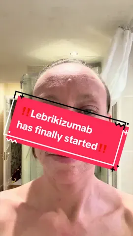 ‼️TWO WEEKS NMT‼️ - Very very tight today, face covered in crusts & flakes, some open wounds too from rubbing in my sleep & can’t open my mouth really! But on another note…. - I’ve also started my Lebrikizumab yesterday… Loading dose of 500mg for first month then 250mg every 2 weeks until November! Also start the slow taper down of my Ciclosporin as of today too, starting with 25mg less for first two weeks.. which I’m very nervous about but time will tell!! - #TSWCommunity #NMT #Biologics #TSWWarrior #HealingJourney