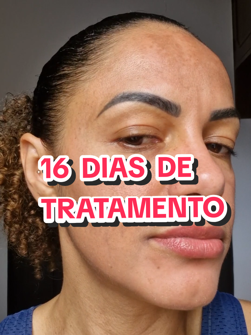 16 dias de tratamento e eu resolvi mostrar tudo mesmo! Sem filtro, sem esconder nada. Ainda não acabou… mas olha essa diferença. Agora me fala: você teria coragem de começar assim ou só depois do resultado pronto? #cuidadoscomapele #skincare #skincareroutine #melasma #melasmatreatment 