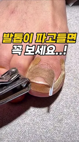 📌 프로필링크 138번에서 확인할 수 있어요 👉 바로가기 : @Decomyhome_official 발톱이 살을 파고들면 걷는 것도 너무 아프죠. 이건 눌리는 압박부터 줄여주더라고요. 처음엔 작은 밴드가 효과가 있을까 싶었는데 직접 써보니 발톱 사이에 공간이 생겨 한결 편해졌어요. ✔️ 밴드로 발톱 압박 완화 ✔️ 교정 스틱으로 발톱을 조금씩 펴줌 ✔️ 방수라 샤워와 일상생활도 가능 #내성발톱 #발톱교정 #발관리 #풋케어 #생활꿀템