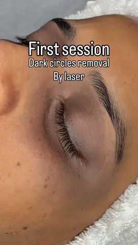 Tired-looking eyes? It’s time to refresh your look. Dark circles can be caused by pigmentation, sun exposure, genetics, or aging. For suitable candidates, advanced laser treatment can help improve the appearance of pigmented dark circles and create a brighter, more refreshed under-eye area after a personalized assessment. ✨ Brighter eyes. Refreshed confidence.  #EyeRejuvenation #SkinRejuvenation #AestheticClinic #undereyerejuvenation #CureMeMedicalComplex 