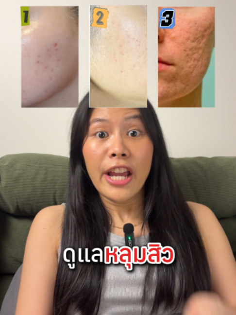 ดูแลหลุมสิว #สิว #หลุมสิว #หน้าสิวหน้าขวาน