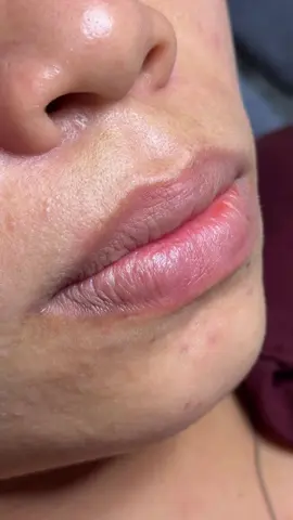 Tớ mất hơn 2tháng để có được chiếc video mượt mà như thế nàyyyy🩷🩷 khử thâm là điều đúng đắn nhất mà khách nói lại mỗi khi gặp lại tớ 🥰🥰#khuthammoi #phunmoitunhien #76quangngai #phunmoitanvien #phunxamquangngai 