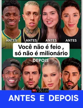 Antes e Depois!!!  #harmonização #ViniJr #Virgínia #famosos #MC 