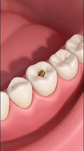 Tiny Food Fragment Removed From a Deep Molar Cavity #CavityCleaning #DentalTreatment #usa 