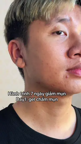 Hành trình giảm mụn của vị khách nhà Mocha #mochavietnam #tiktokshop88 #gelmunmocha #damun 