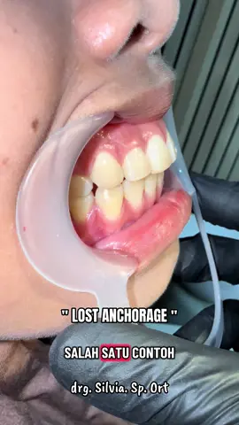 Lost anchorage Kehilangan Penjangkaran akibat kesalahan perawatan yang dilakukan pihak non kompeten pada saat penarikan. Ciri khas terjadi gigitan tonjol, geraham maju ke depan menjadi relasi kelas 2 , profil memburuk bukan mundur tapi tambah tongos. Korban malpraktek seperti ini g terhitung jumlahnya di negara yang tidak ada aturan tegas tentang kompetensi pemasangan behel. Tugas saya edukasi saja, siapa tahu dari edukasi ini rakyat bisa menangkap maksud baik saya agar tidak menjadikan behel sebagai kebutuhan utama bila maloklusi tidak parah dan bila parah lebih baik menabung dan pasang behel langsung ke sp orthodonsia yang sudah banyak tersebar di penjuru nusantara. Pihak pihak non kompeten yang sadar pasti tidak akan mau mengerjakan sesuatu yang bukan bidangnya karena disumpah di hadapan Tuhan saat pelantikan.  Dunia sementara akhirat selamanya, ingat mati saja. Salam edukasi drg. Silvia. Sp. Ort #behelgigi #malpractice #orthodontist #edukasi #fyp
