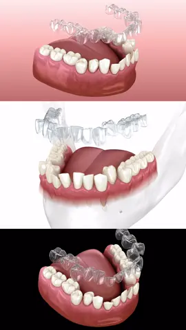 Clear aligners — lower arch correction. 3D animation.