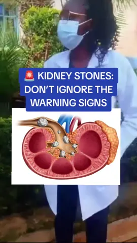 #creatorsearchinsights  ✅ A kidney stone is a hard, crystal-like deposit that forms inside the kidneys when certain minerals and salts in the urine become concentrated and stick together.  ✅Small stones may pass on their own, while larger ones can cause severe pain or block urine flow. ⚠️ Severe side/back pain  • Pain when urinating  • Blood in urine  • Nausea/vomiting ✅That sharp pain in your side or lower back may be more than just “normal pain. ✅Kidney stones can become serious when they block urine flow or lead to complications ✅Are you experiencing recurring pain or urinary symptoms?  ✅Don’t keep guessing get checked and know what’s really going on.  📲 Reach out to us today. #KidneyStones #KidneyHealth #nairobitiktokers #tiktoktrendingvedio 